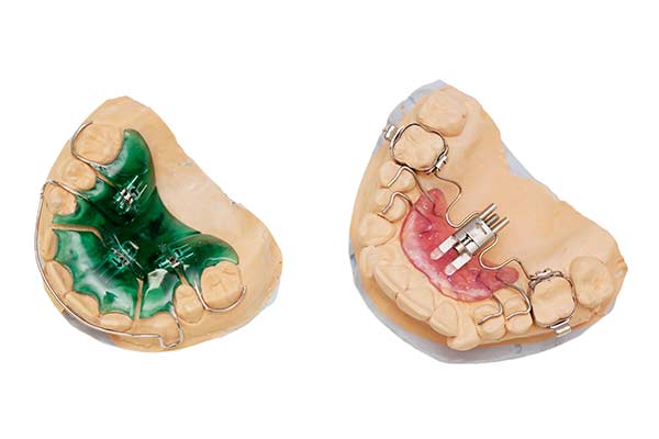 Palatal Expander - part of orthodontic treatment at Soleil