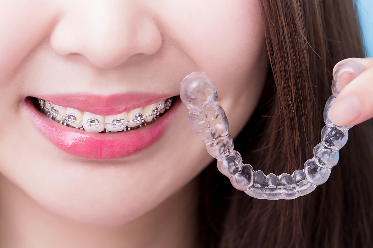 Differences Between Braces & Clear Aligners