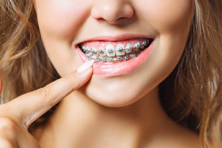 How Common Are Crossbites? | Castle Hills 3D Orthodontics