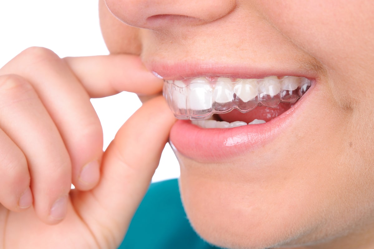 How Does Invisalign Work? | Castle Hills 3D Orthodontics