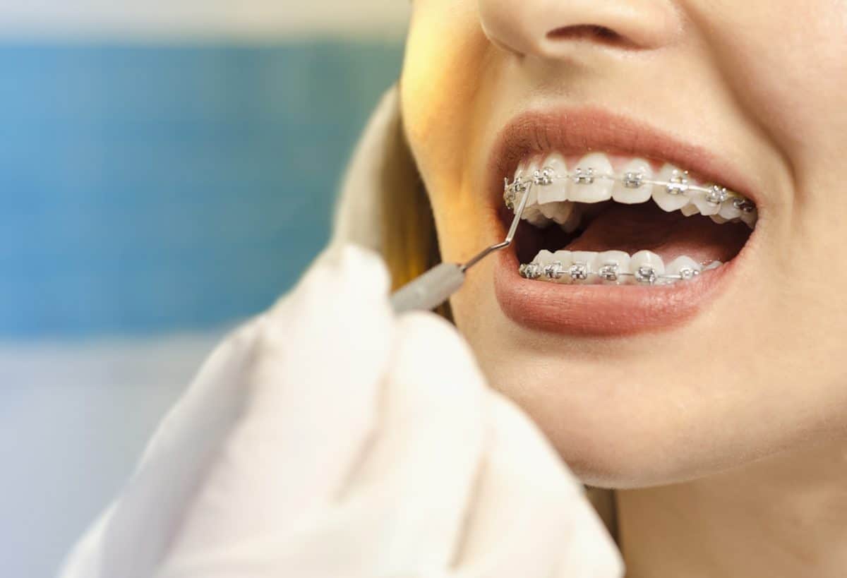 close up dental braces checkup